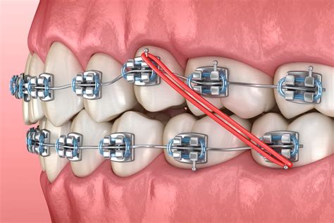 para que sirven las ligaduras metalicas en los brackets|goma para brackets.